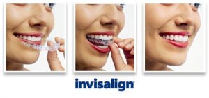 Invisalign: Alternative to metal braces. Dunwoody, GA.