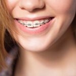 Close up portrait of smiling teen girl showing dental braces. Dunwoody, GA.