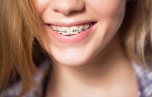 Close up portrait of smiling teen girl showing dental braces. Dunwoody, GA.