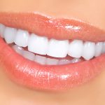 Woman Teeth Porcelain Veneers Dunwoody GA