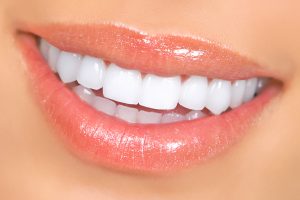 Woman Teeth Porcelain Veneers Dunwoody GA