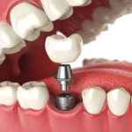 Dental Implants Dunwoody GA