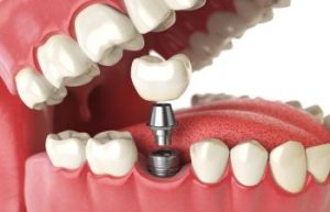 Dental Implants Dunwoody GA