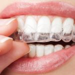 woman puts on invisalign close up on lips 1